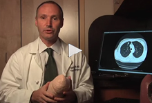 Lung Cancer Surgery video